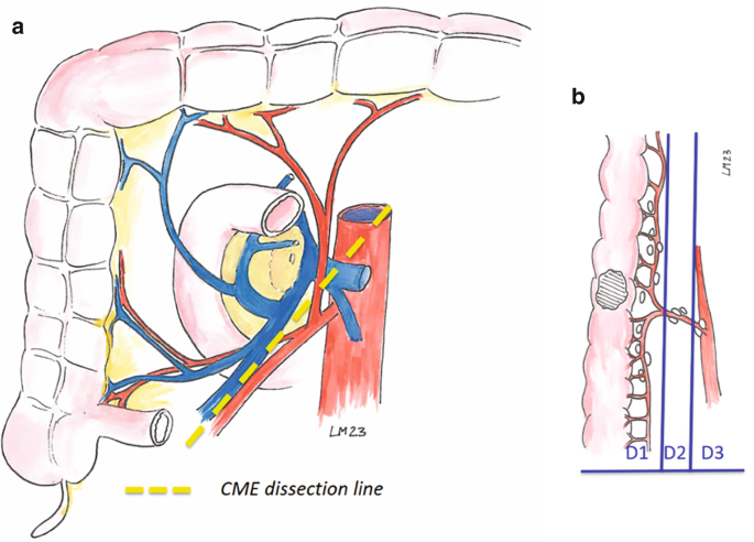 2 diagrams. A presents a section of the large intestine and blood vessels around it. A slanting C M E dissection line is present in the diagram. B has a section of the large intestine with blood vessels. A tumor is present in the large intestine. The draining nodes D 1, D 2, and D 3 are present.