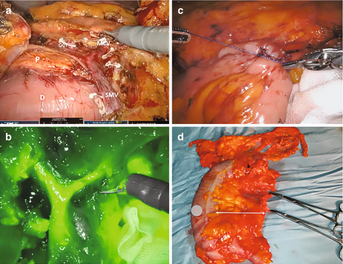 4 intra-operative close-up photographs. A has the inner view of the abdomen with large masses. The labeled parts are G C T, M C V, P, D, and S M V. B. An instrument is inserted in the middle colic vessels. C. 2 robotic hands remove the intracorporeal connections with the thread. D. A removed mass is kept on a surface.