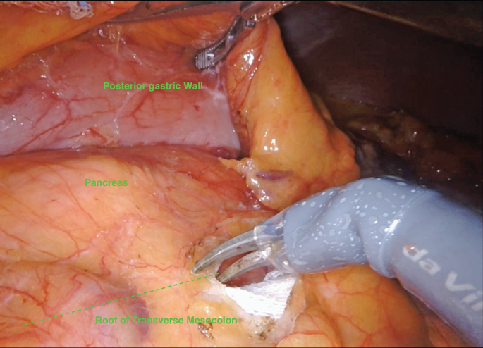 An intraoperative photograph of the posterior gastric wall, pancreas, and root of the transverse mesocolon which is incised from the pancreatic tail.