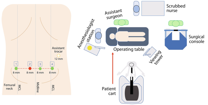 A diagram represents the patient positioning, Trocar layout, and operating room setup, The patient is placed in a supine position on the operation table. The anesthesiologist stations on the head side, the patient cart is on the right, and the assistant surgeon is on the left side of the patient.