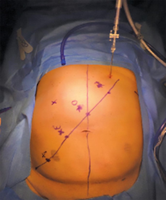 A photograph represents the abdominal region marked with two intersecting lines drawn and trocar positions marked over the plane. A thin needle-shaped device is impregnated from the top.
