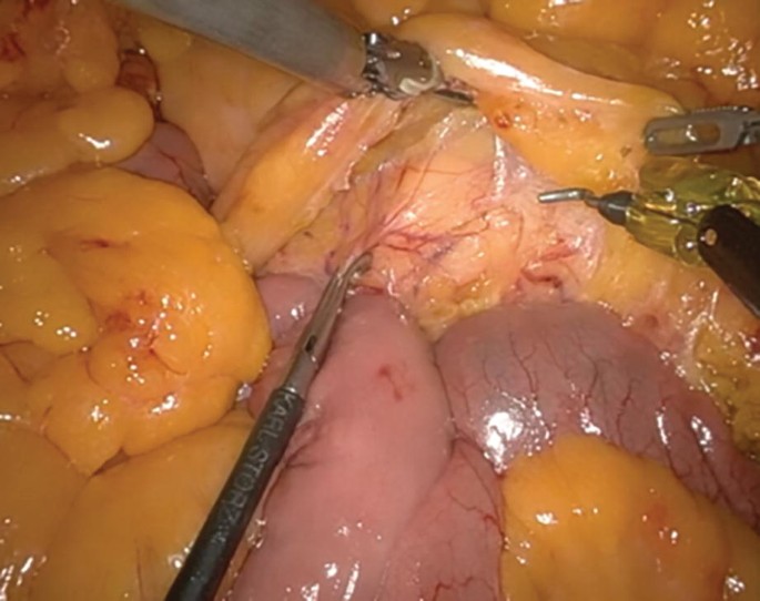 An intra-operative photograph presents a mass lesion with bulges at the top. A pointed surgical device holds the thin tissue layer from the top and another device with a needle is impregnated into the mass.