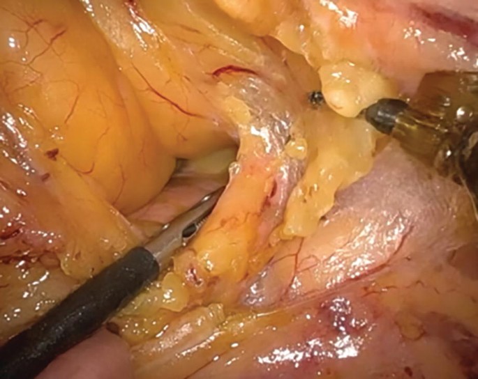 An intra-operative photograph presents a cylindrical surgical device with a pointed blade in the front that is pressed over the mass lesion. Another device with a pointed needle is impregnated into the mass lesion.