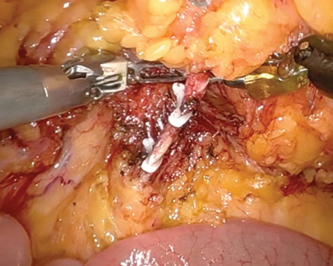 An intra-operative photograph presents a mass lesion with small curved protrusions. A surgical device with a blade dissects the mass lesion while another device presses the mass to support the dissection.