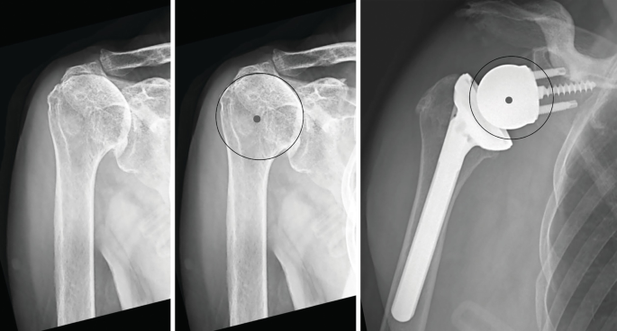 Three radiographs of the right shoulder of a patient. They highlight the center of rotation relative, which lies in the humeral head.