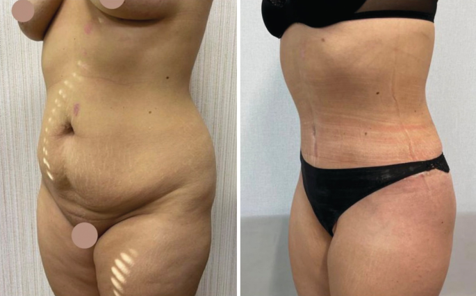 Abdominoplasties in Combination with Radiofrequency, Ultrasound