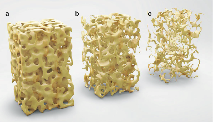 A photo of 3 cuboidal bone structures. A. Densely packed irregular pores in the bones. B. Lightly packed pores. C. Thick threads of bones intertwined with each other.