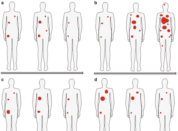 4 illustrations of patterns of response of the radiotracer in the body. The patient has dots marked over the upper portion of the body.