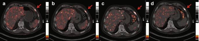 4 axial sections of the abdominal region of dotted intensity appear in the liver and spleen.
