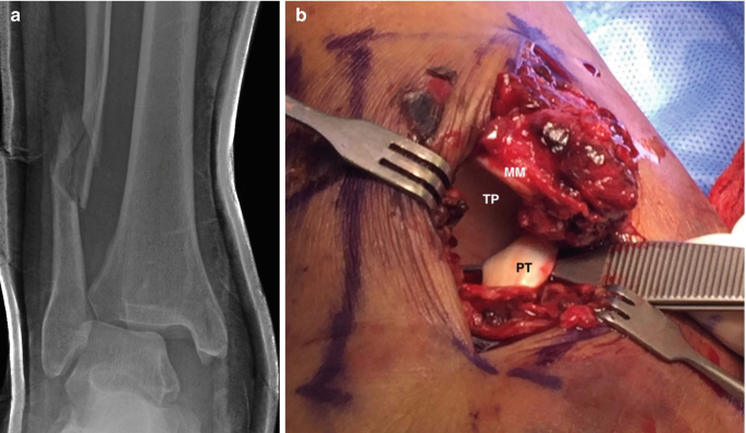 A radiograph and a clinical image of an ankle fracture. An intraoperative photo of the fibula fracture. In the clinical image, the skin is cut and pulled apart using surgical equipment to expose the displaced posterior tibial tendon.