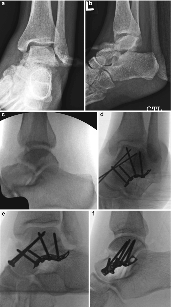 Management of Talus Fractures | Springer Nature Link
