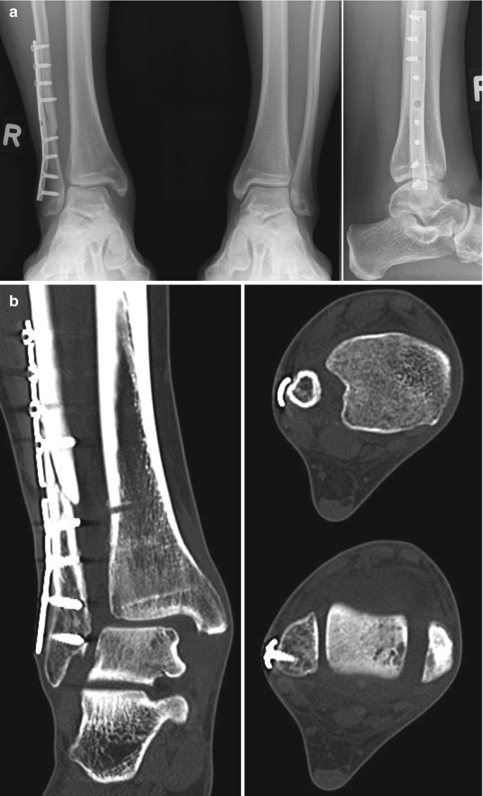 A has 2 standing radiographs of the anterior and lateral views of the screws fixed with a board in the tibia. B has 2 C T scans of the screws fixed in the tibia. A cross-sectional view is provided.