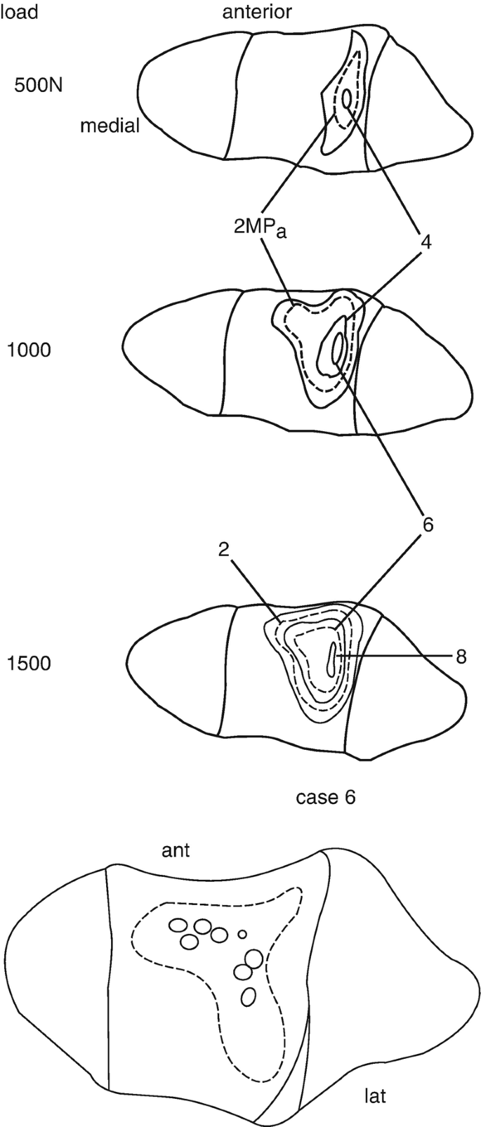 A schematic for the results of the force study. The contact area is in the anterior, measuring 2 megapascals with loads of 500 and 1000 Newton. The contact area is surrounded by contour lines measuring 4, 6, and 8 megapascals with loads of 1000 and 1500 Newton.