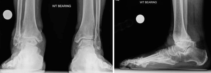 Ankle Joint  SpringerLink