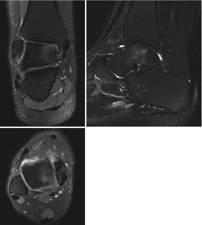 Three radiographs of the feet with the lesion in the ankle.