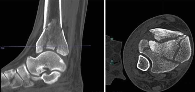 Two C T scans of the ankle joint highlight the multiple cracks in the fibula and tibia from the lateral side on the left and in the coronal view on the right.