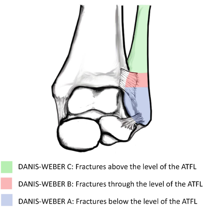 Classification of Ankle Fractures