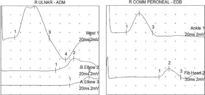 2 line graphs of conduction velocity versus time. A has 3 fluctuating lines for wrist 1, elbow 2, and elbow 3. The lines have labeled points on them. Peaks are at point 2. B has 2 fluctuating lines for ankle 1 and fib head 2. The lines have 3 labeled points on them with a peak on point 2.