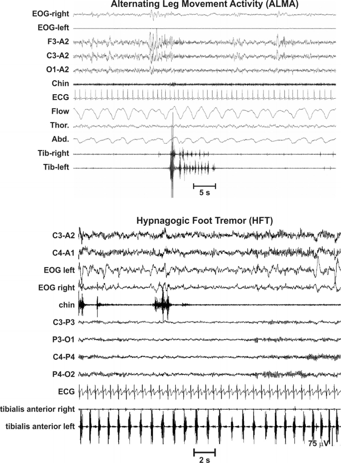 A polysomnograph and an electromyograph. The former depicts fluctuating lines for E O G-right, F 3-A 2, and others. The latter presents highly fluctuating lines for C 3-A 2, E O G left and right, and others. In the former, the consecutive fluctuating region is labeled 5 seconds in tibialis left.