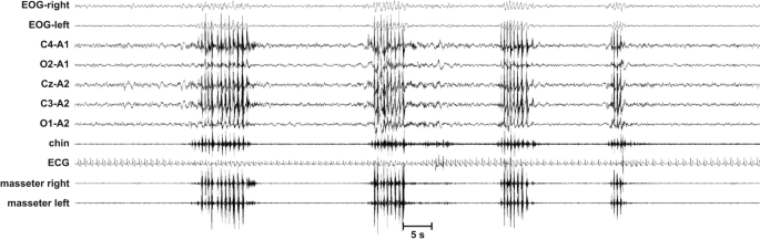 A polysomnograph. It presents horizontal fluctuating lines for E O G-right, E O G-left, C 4-A 1, O 2-A 1, C z-A 2, C 3-A 2, O 1-A 2, chin, and E C G. The massester right and left are indicated by horizontal lines with fluctuating regions.