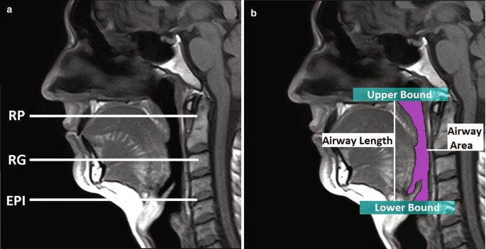 A 2-part cine M R I image of the lateral view of the upper airway. R P, R G, and E P I are marked in part A, and in part B the airway area is highlighted along with the labels of the upper and lower bound and the airway length.