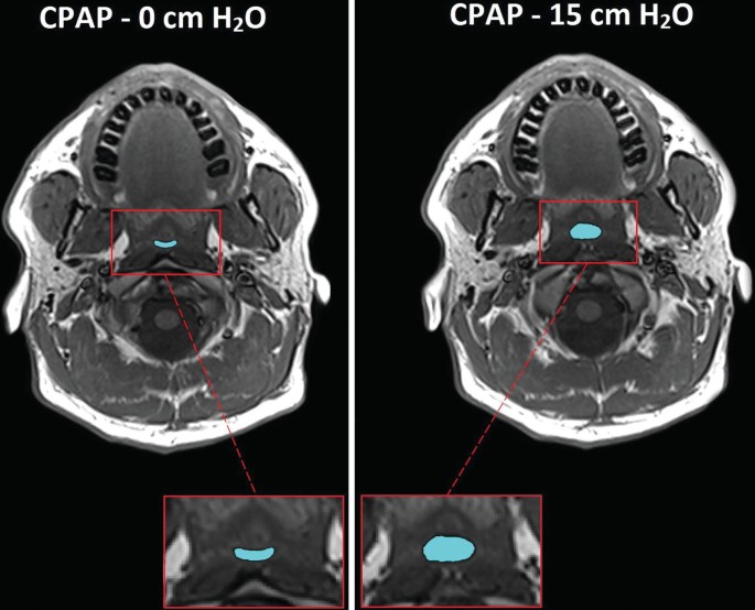 2 M R I images of the axial view mark the increase in the C P A P. The left image is for C P A P as 0 centimeters H 2 O, and the right image is for C P A P as 15 centimeters H 2 O.