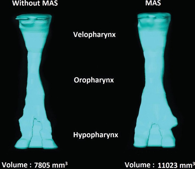 An upper airway M R I image displays the velopharynx, oropharynx, and hypopharynx without M A S, and with M A S.