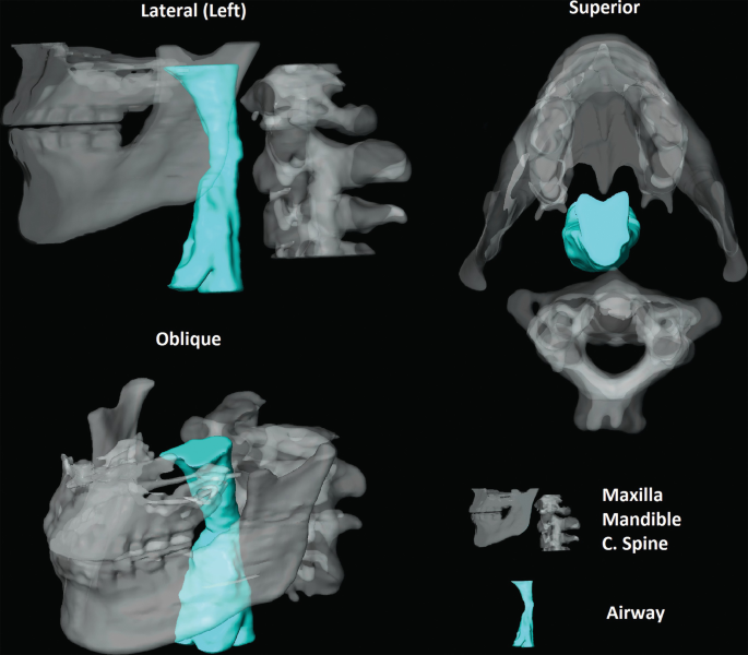 A 4-part image of the 3-D reconstruction of the upper airway lumen. The top left is the reconstruction of the left lateral view, the top right is the reconstruction of the superior view, and the bottom left is the reconstruction of the oblique view. The maxilla, mandible, and C spine are reconstructed in the images and the airway is also highlighted.