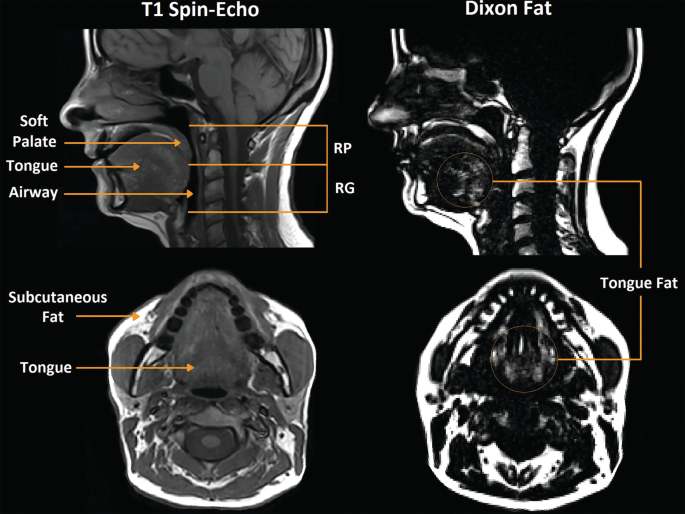 4 M R I images of the tongue. The top left is the lateral image of the T 1 spin - echo, the labels are soft palate, tongue, and airway. The retropalatal and retroglossal airways are also marked, the top right is the lateral image of the Dixon fat, the bottom left is the axial image of the upper airway lumen, and the labels are subcutaneous fat and tongue.