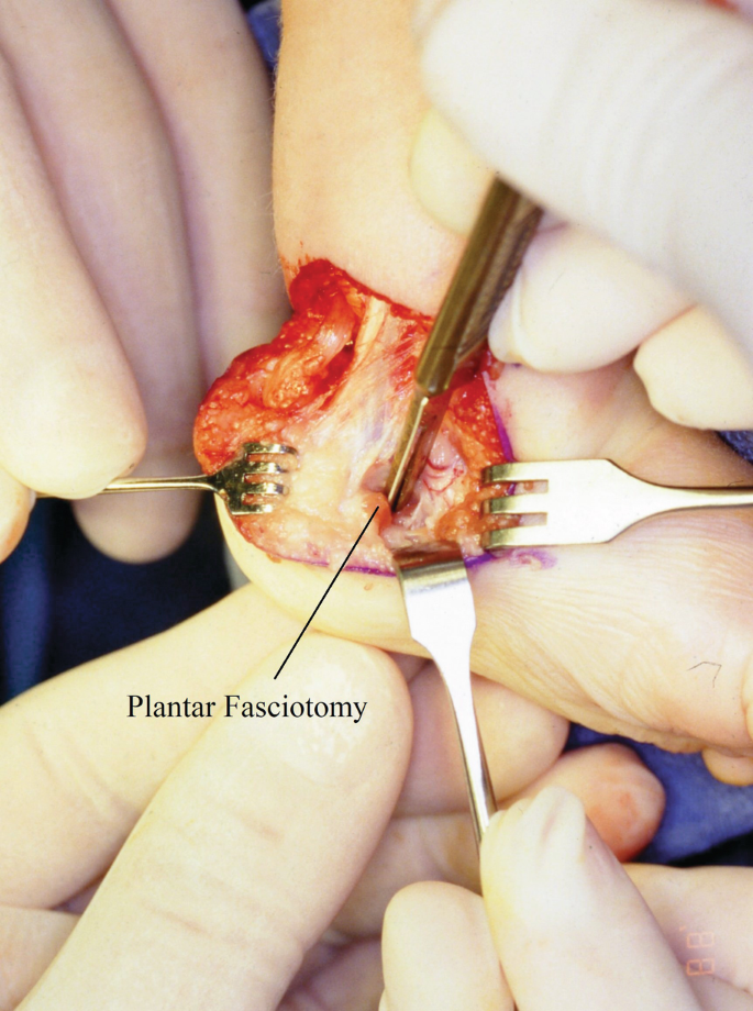 Surgical Release for Clubfoot: Principles, Indications, and