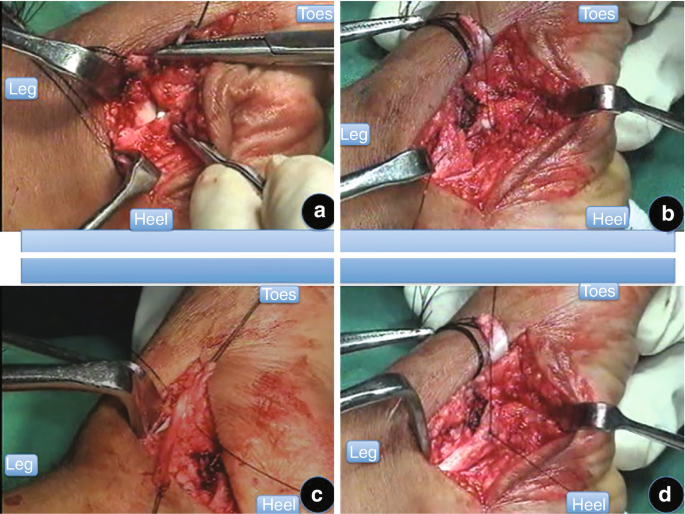 Extensive Soft Tissue Release for Congenital Vertical Talus