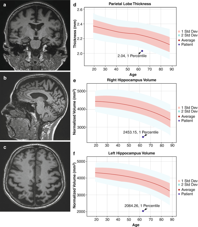 3 M R I scans and 3 graphs. A, B, and C are the M R I scans that highlight the coronal, sagittal, and axial sections and present the location and pattern of atrophy in the brain. D, E, and F are the graphs of thickness and normalized volumes versus age. Each graph has a decreasing line, 2 bands, and a plot.