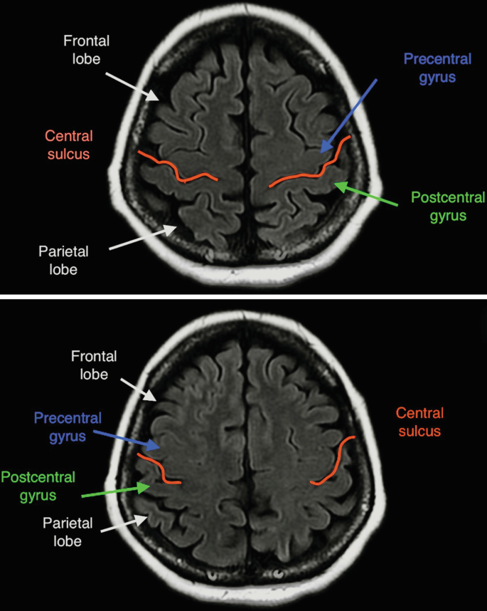 2 M R I of the axial views of the brain has the following labels. The frontal lobe, precentral gyrus, postcentral gyrus, central sulcus, and parietal lobe.