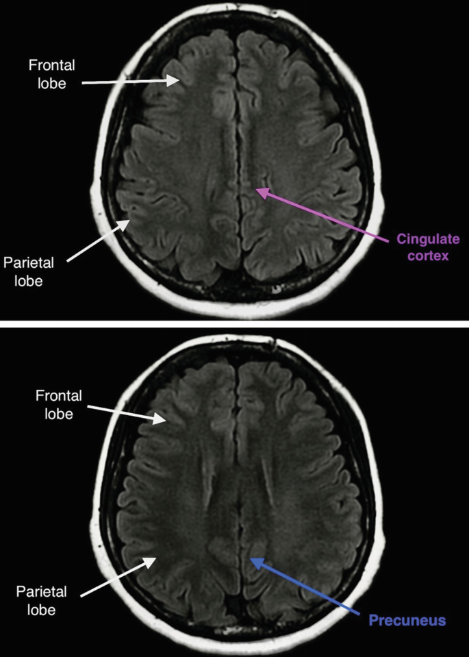 2 M R I of the axial views of the brain has the following labels. The frontal lobe, cingulate cortex, precuneus, and parietal lobe.