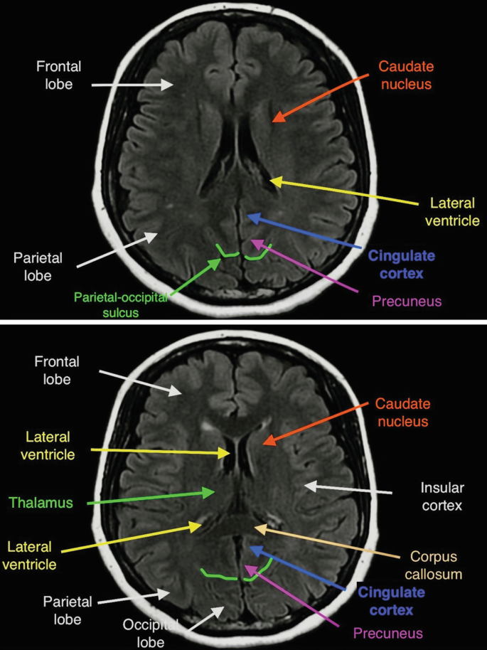 2 M R I scans. They illustrate the axial views of the brain. It is labeled frontal lobe, parietal lobe, parietal-occipital sulcus, caudate nucleus, lateral ventricle, cingulate cortex, precuneus, thalamus, occipital lobe, insular cortex, corpus callosum, and insular cortex.
