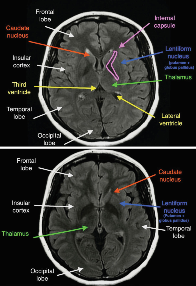 2 M R I scans. They illustrate the axial views of the brain. It is labeled frontal lobe, caudate nucleus, insular cortex, third ventricle, temporal lobe, internal capsule, lentiform nucleus, lateral ventricle, thalamus, and occipital lobe.