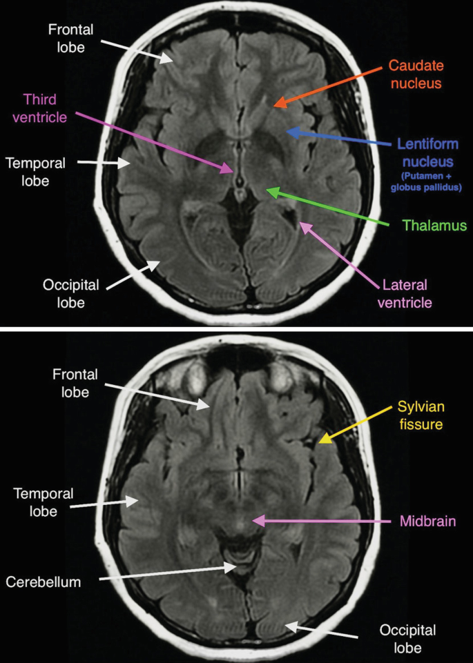2 M R I scans. It illustrates the axial views of the brain. It is labeled frontal lobe, third ventricle, temporal lobe, occipital lobe, caudate nucleus, lentiform nucleus, thalamus, lateral ventricle, cerebellum, Sylvian fissure, and midbrain.