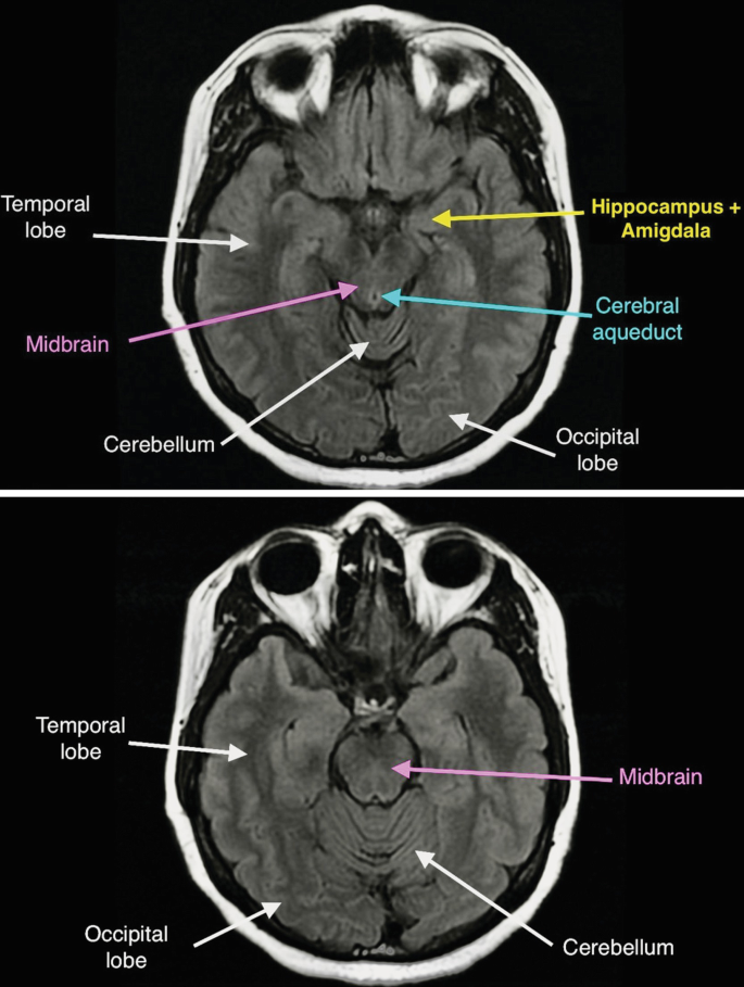 2 M R I scans. They illustrate the horizontal plane of the brain. It is labeled temporal lobe, midbrain, cerebellum, hippocampus plus amygdala, cerebral aqueduct, and occipital lobe.
