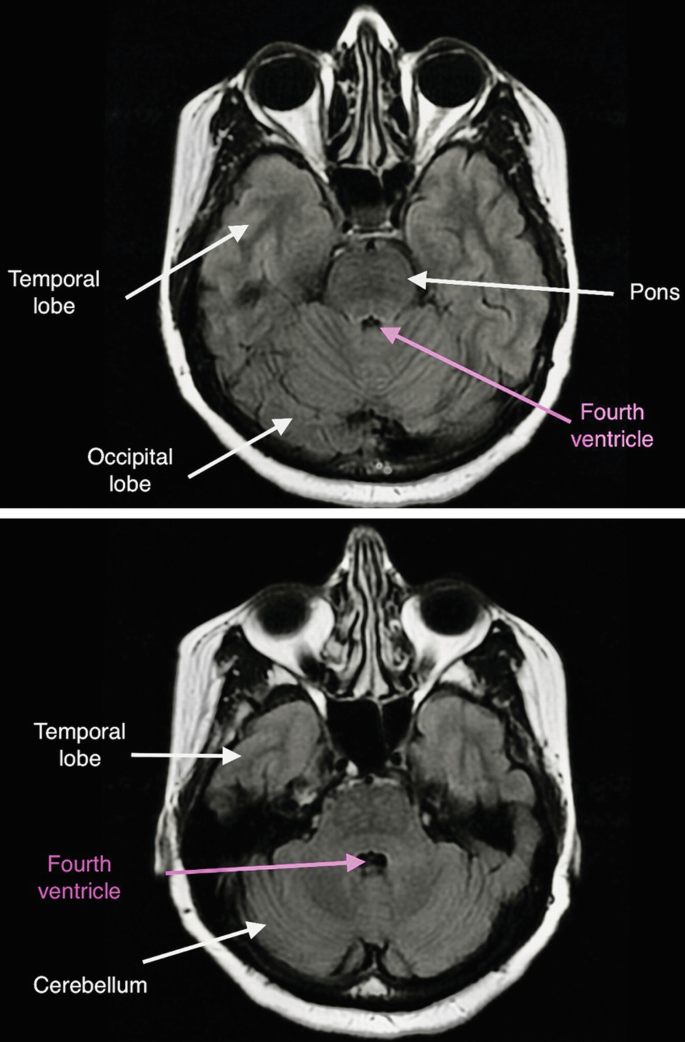 2 M R I scans. They illustrate the horizontal plane of the brain. The labels read temporal lobe, occipital lobe, pons, fourth ventricle, and cerebellum.