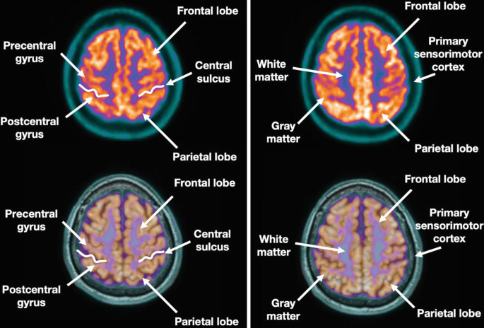 4 P E T scans. They illustrate the axial views of the brain. The labels are the frontal lobe, central sulcus, parietal lobe, postcentral gyrus, precentral gyrus, white matter, grey matter, and primary sensorimotor cortex.
