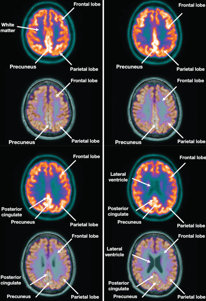 8 P E T scans. They illusterate the axial views of the brain. The labels are the frontal lobe, parietal lobe, precuneus, white matter, lateral ventricle, and posterior cingulate.