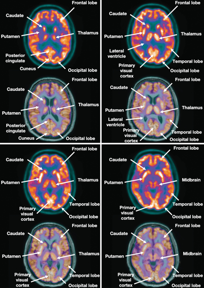 8 P E T scans. They illustrate the axial views of the brain. The labels are the frontal lobe, thalamus, midbrain, temporal lobe, occipital lobe, primary visual cortex, lateral ventricle, putamen, cuneus, and caudate.