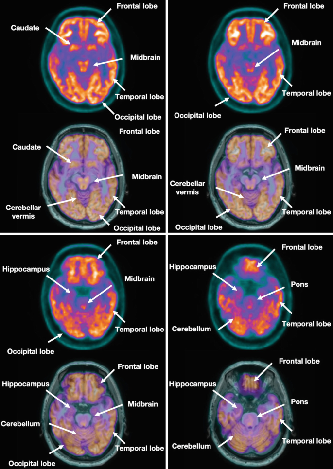 8 P E T scans. They illustrate the axial views of the brain. The labels are the frontal lobe, midbrain, temporal lobe, occipital lobe, cerebellar vermis, caudate, pons, cerebellum, and hippocampus.