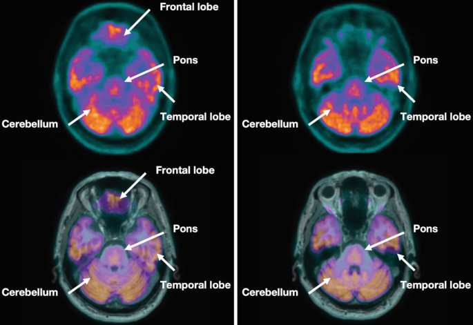 4 P E T scans. They illustrate the axial views of the brain. The labels are the frontal lobe, pons, temporal lobe, and cerebellum.