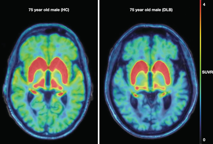 2 F E O B V P E T scan images of 2 aged male patients with no dementia and dementia, respectively. A shaded scale of S U V R values from 0 to 4 indicates low and high uptake of tracer, respectively.