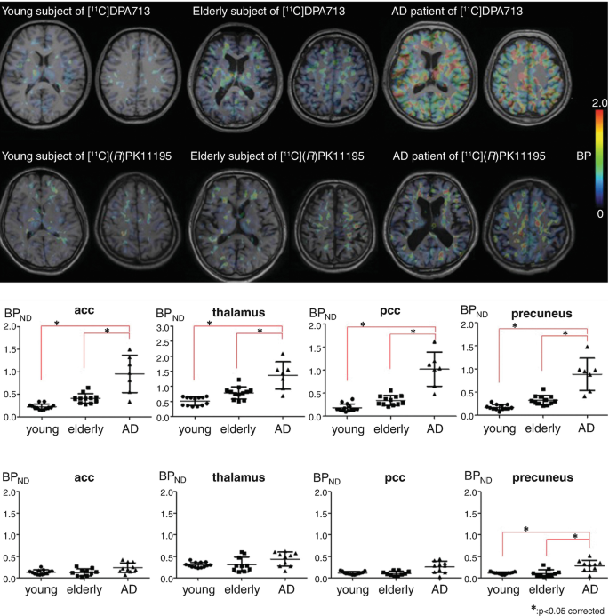 12 scan images of the brain and 8 graphs. The scans are of young subjects, elderly subjects, and A D patients. A scale of B P ranges from 0 to 2.0. The graphs map B P versus 3 categories. They present the binding in a c c, thalamus, p c c, and precuneus.