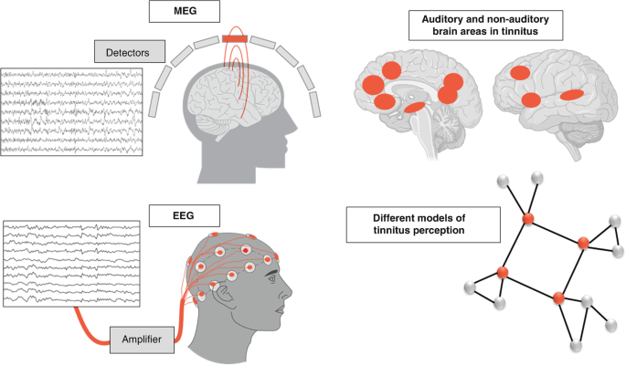 The Electrophysiological Explorations in Tinnitus Over the Decades Using  EEG and MEG | Springer Nature Link