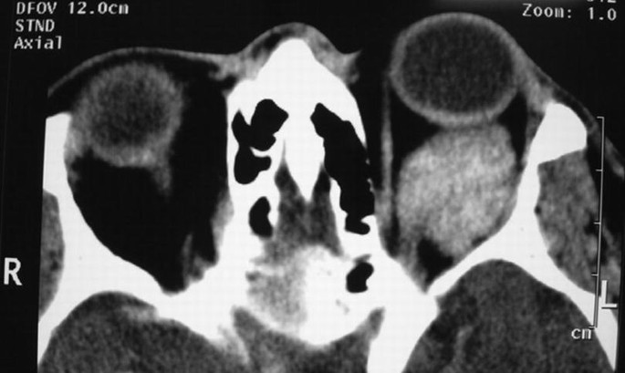 A C T scan of the head of a patient. It illustrates the orbital region. The scan illustrates left orbital malformation and leads to globe displacement.