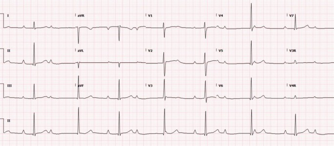 4 Long segments of E C G record for lead 1, 2, 3, and again 2. a V R, a V L, a V F, V 1 to V 7, V 3 R, and V 4 R are marked.