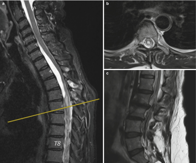 3 M R I sans of the spine. Scans A and B display the presence of an arachnoid cyst in the cervicothoracic region and myelopathy in the lower spine. Scan C reveals the results of surgical procedures related to lipoma removal and C S F leak repair in the lumbosacral region.